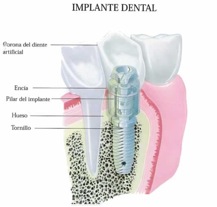 implantes 2